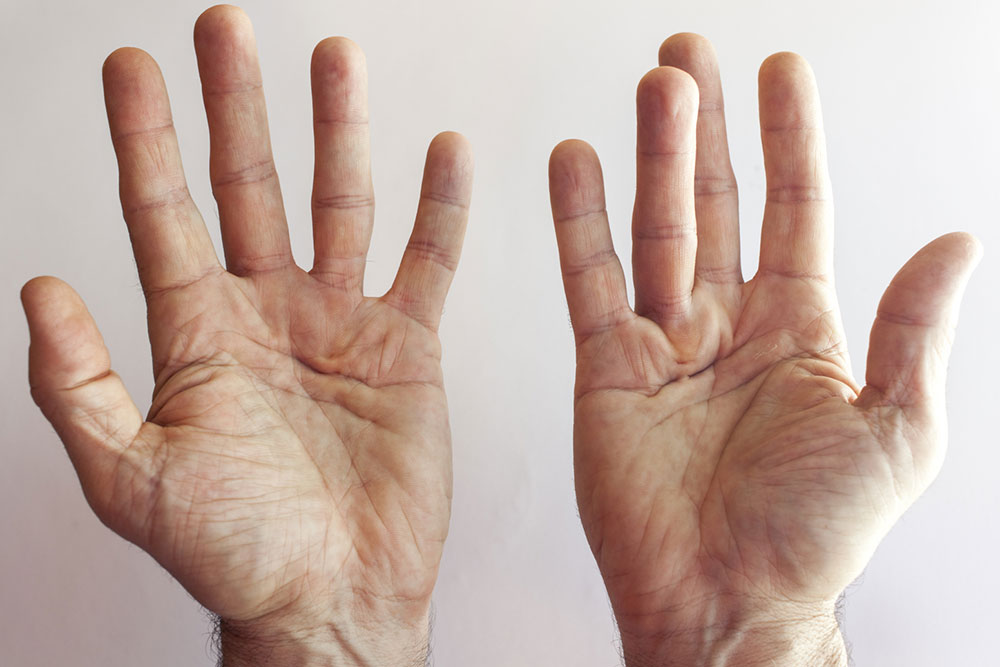 Dupuytren’s Contracture – Its Symptoms and Causes
