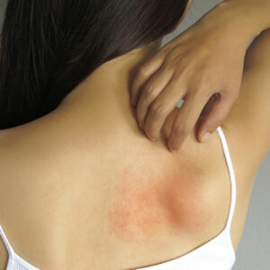 Here’s what you should know about allergies and how to treat them