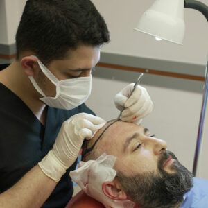 Everything to Know About a Hair Transplant in Turkey